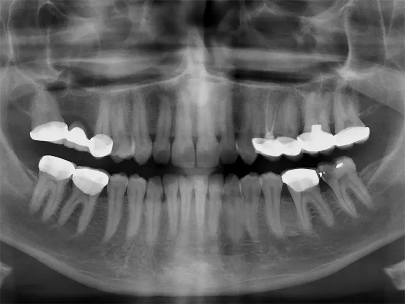 Dental X-ray