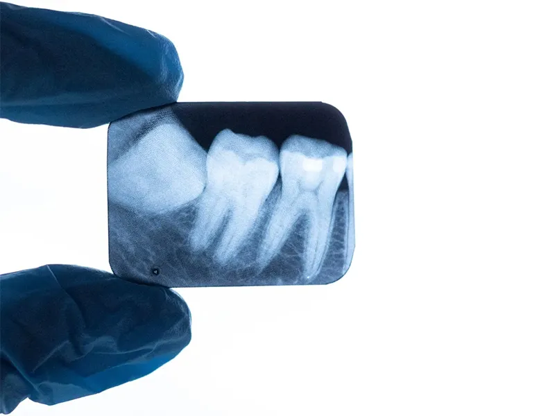 Wisdom tooth extraction