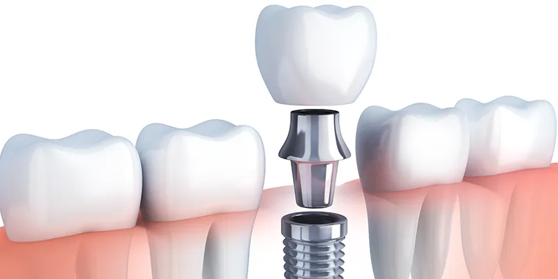 cosmetic treatment dental implants