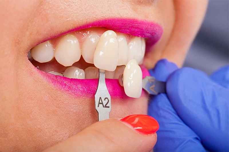porcelain veneers on woman happy