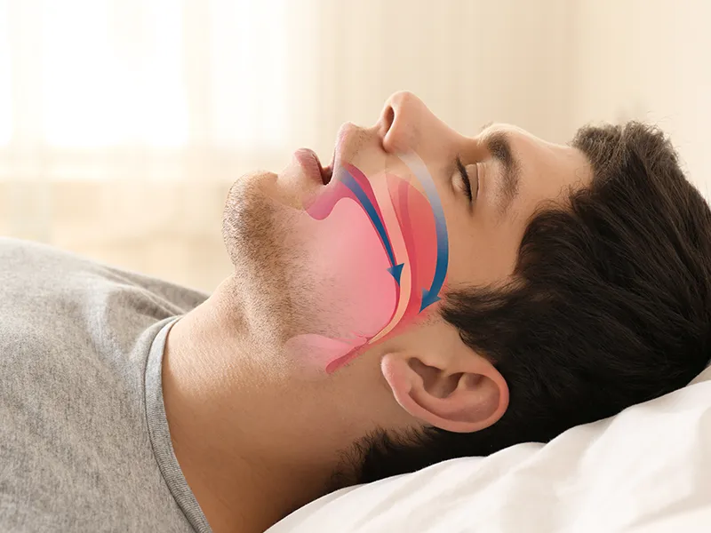 Obstructive sleep apnoea