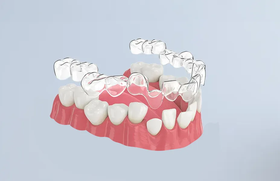 3D printed clear aligners