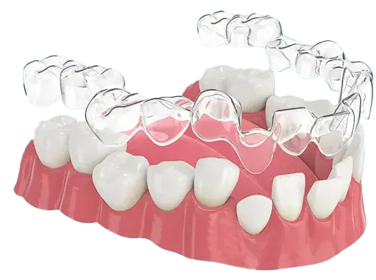 3D printed clear aligners