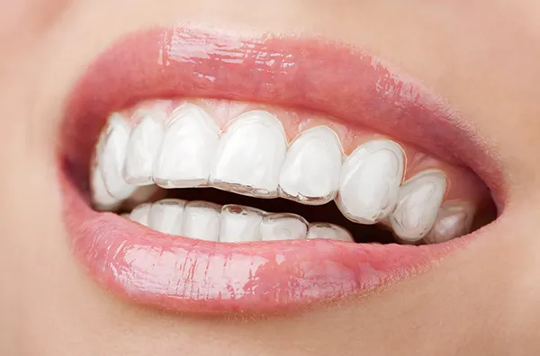 3D printed clear aligners