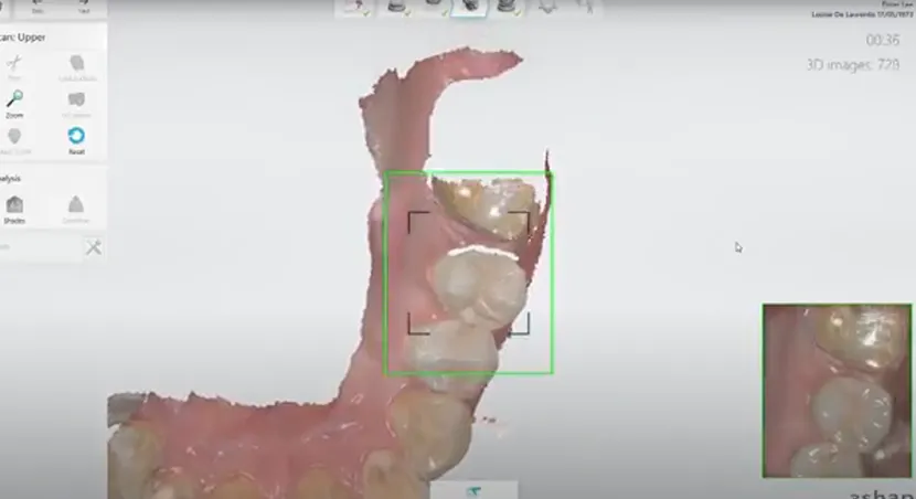 Intraoral 3D scanning