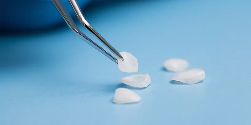 3D printed veneers