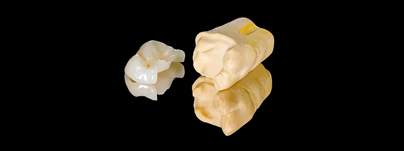 Dental onlays