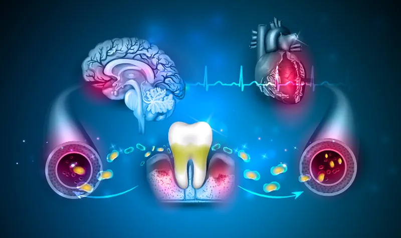 Oral pathogen related-chronic diseases