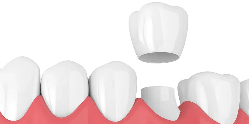 dental crowns