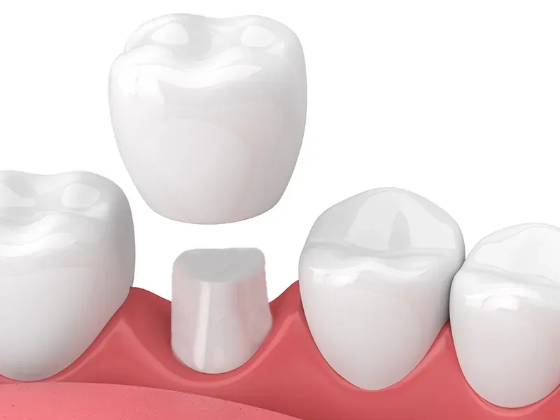 Dental Crowns