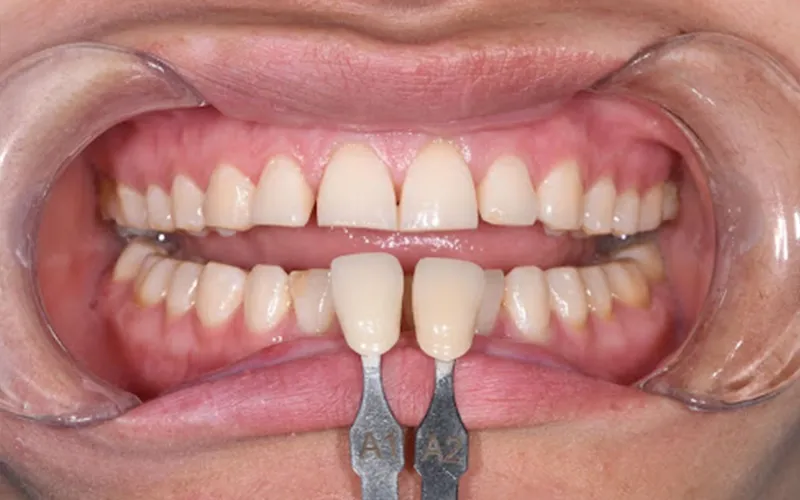 Hybrid ceramic restorations