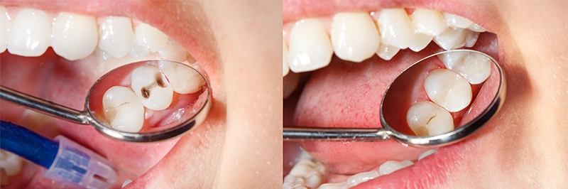 Dental inlays and onlays