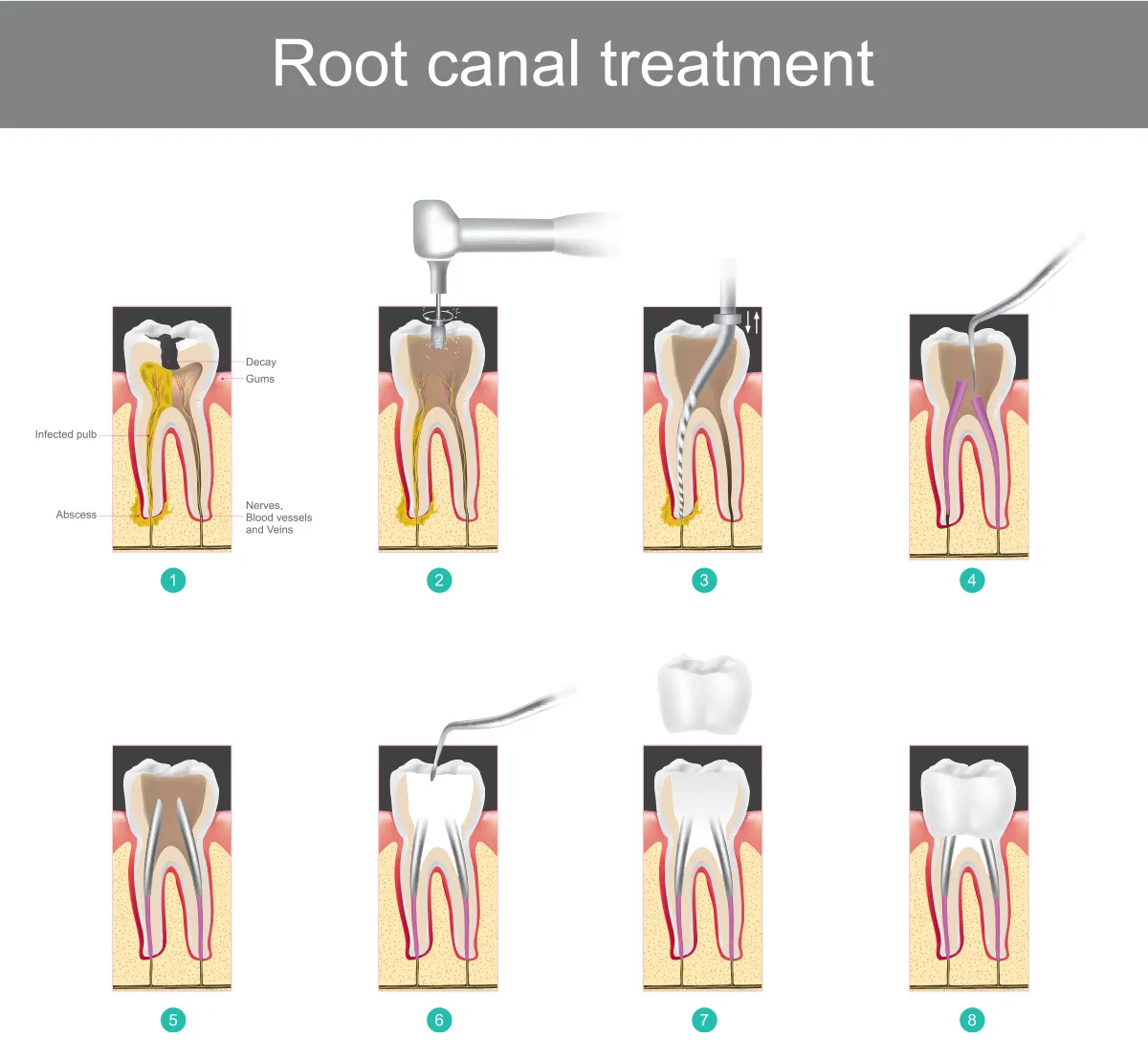 Root canal process