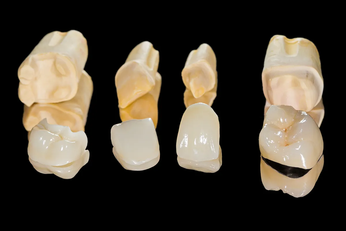 Dental restorations