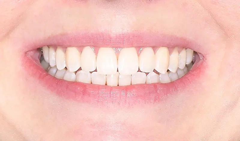 Clear Aligners & 3D Veneers - after Clear Aligners & 3D Veneers - after