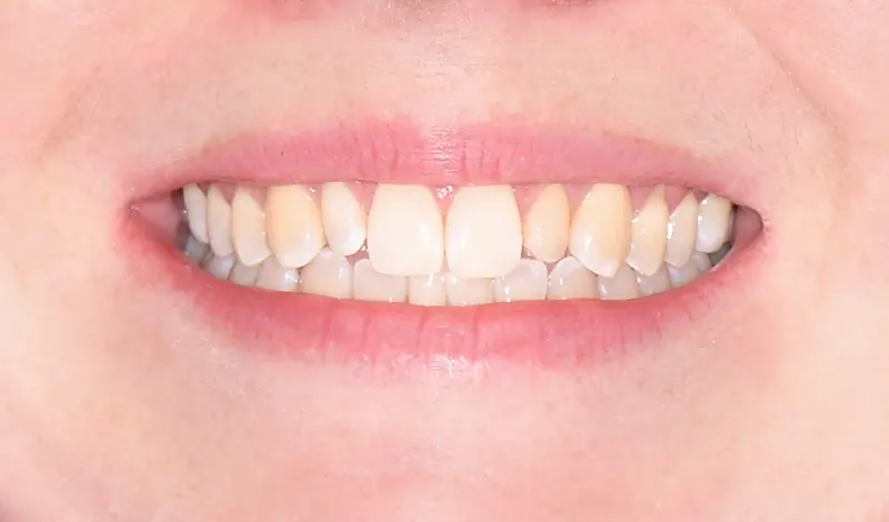 Clear Aligners & 3D Veneers - before Clear Aligners & 3D Veneers - before
