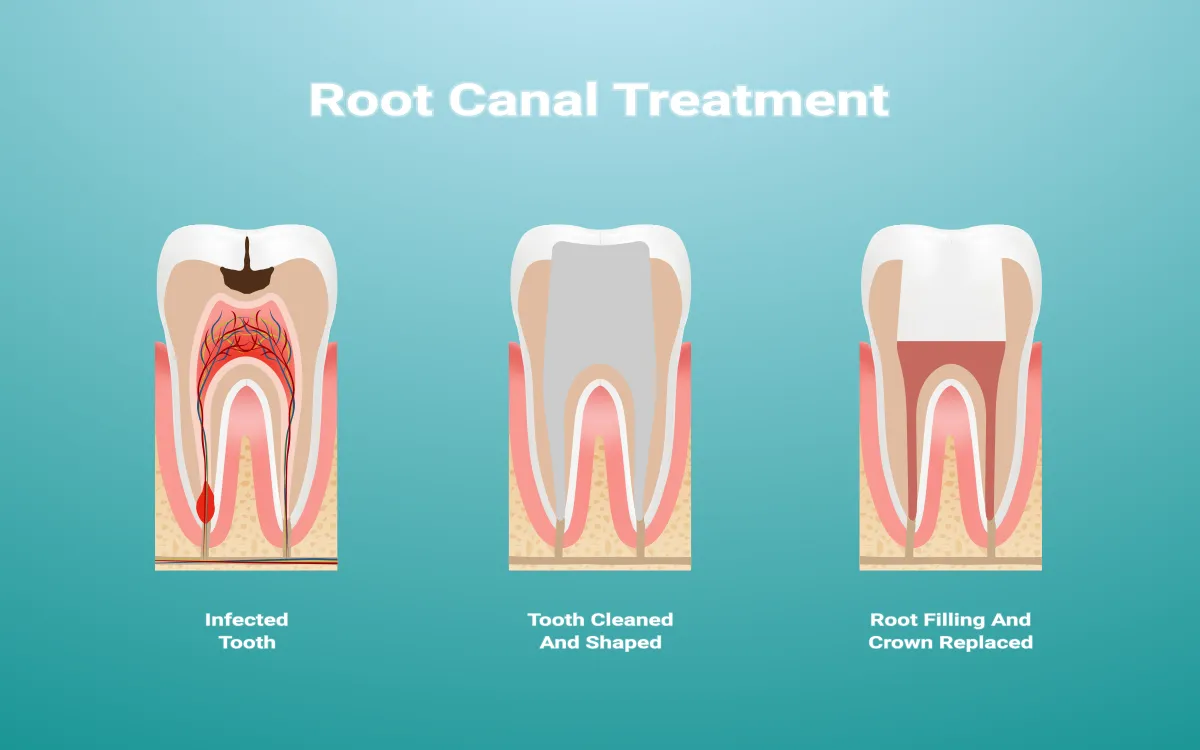 Root canal