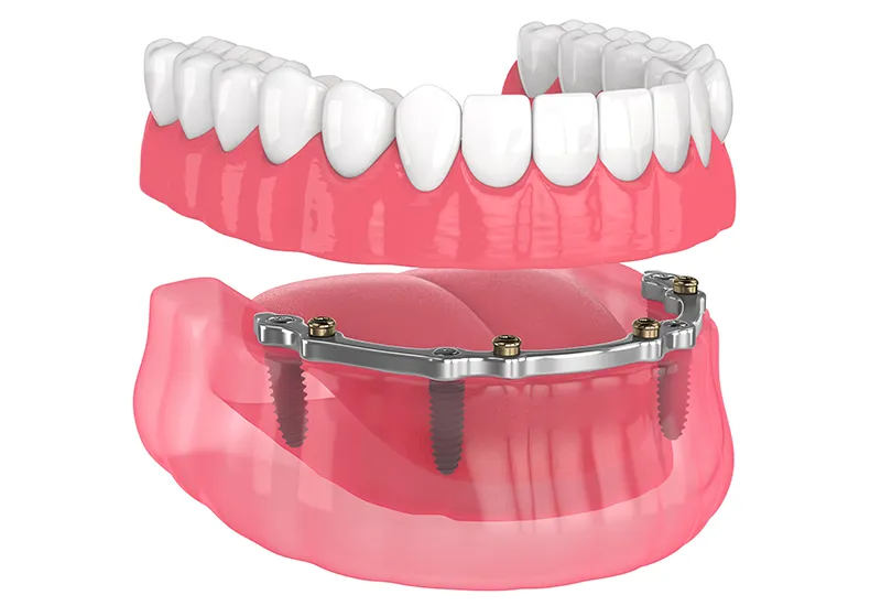 Implant retained dentures