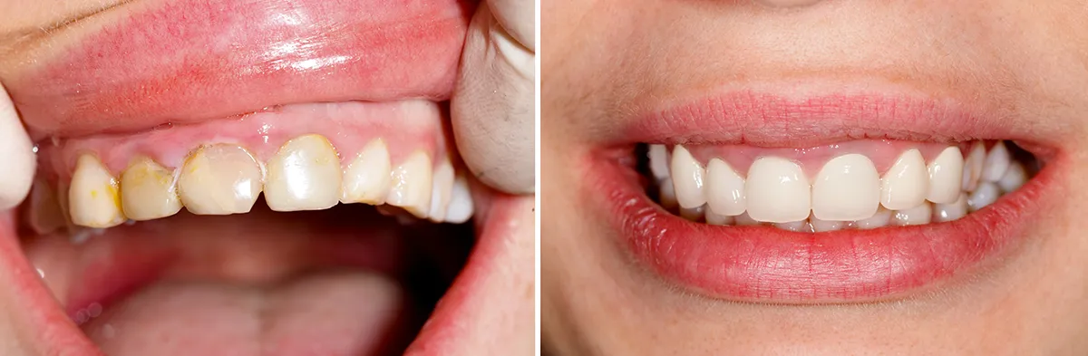 dental plaque