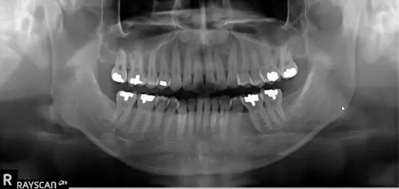 CBCT Scan